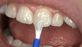 فلورایدتراپیِ دندانِ کودکان را از این سن شروع کنید